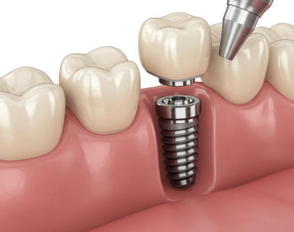 6 Tips For Caring For Dental Implants After Surgery
