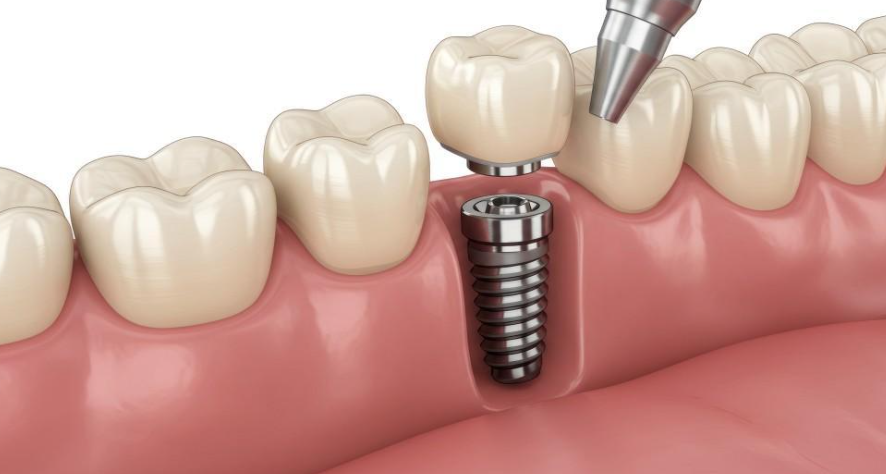 6 Tips For Caring For Dental Implants After Surgery