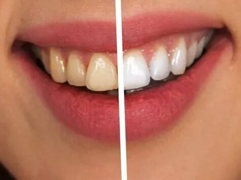 Cosmetic Dentistry For Patients With Naturally Mottled Enamel